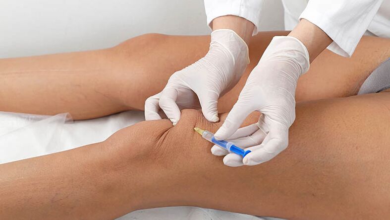 Intra -kartikuläre Injektion bei Knie -Arthrose
