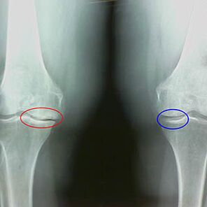 Kniegelenks -Osteoarthritis auf der Radiographie