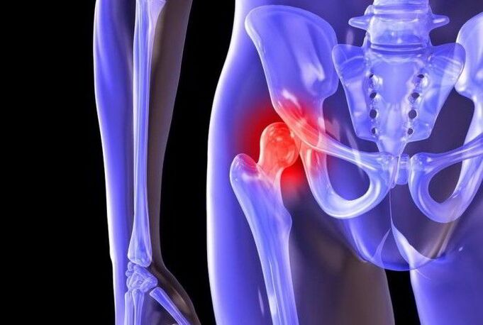 Pathologischer Prozess im Hüftgelenk mit Coxarthrose.